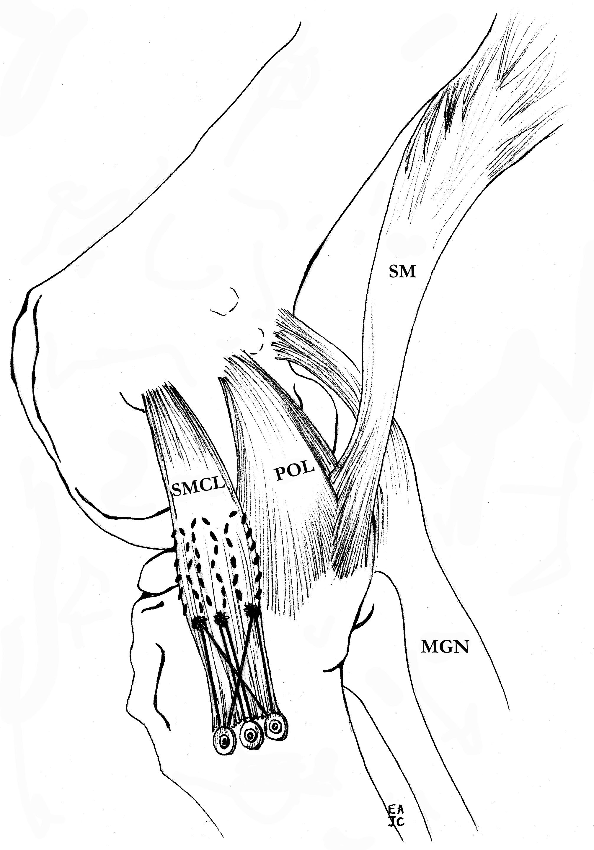 MCL tibial fixation